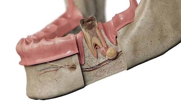 tooth-root-cyst