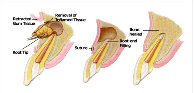 tooth-root-cyst