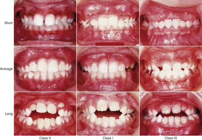 dental-malocclusion