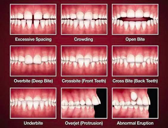 dental-malocclusion