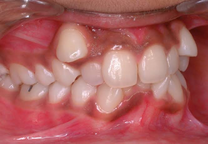 dental-malocclusion