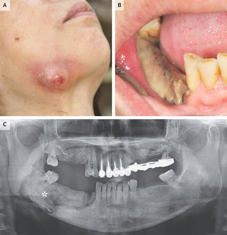 osteonecrosis-of-the-jaw