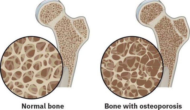 Implants and Osteoporosis