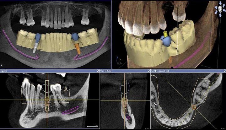 Implants and Osteoporosis