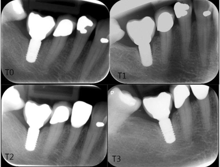 Implants and Osteoporosis