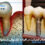 Implants and Osteoporosis