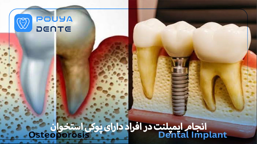 Implants and Osteoporosis