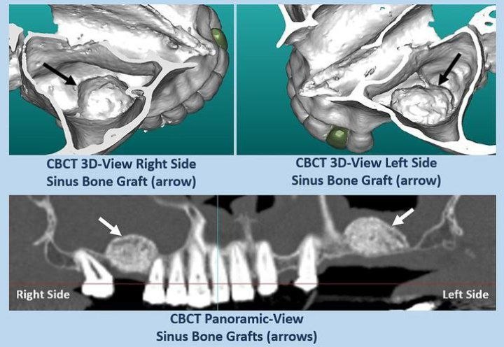 Displacement of the implant into the sinus