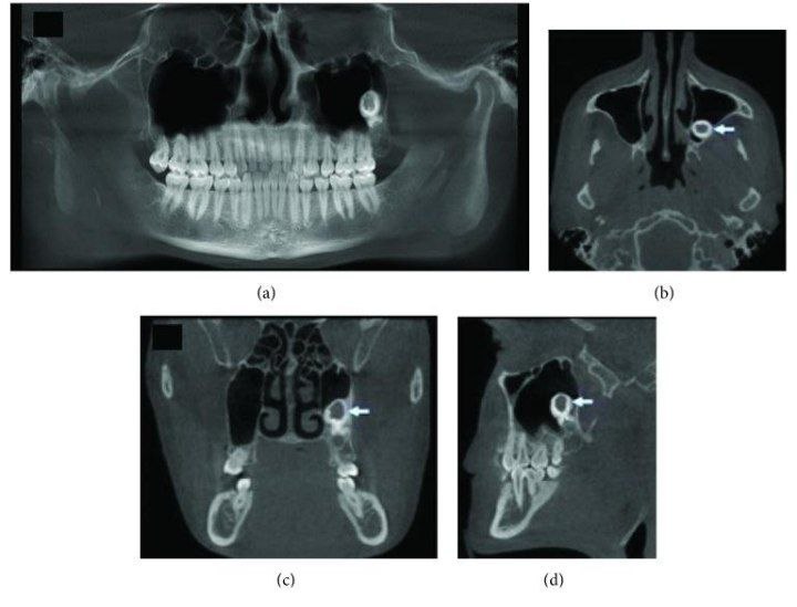 Displacement of the implant into the sinus