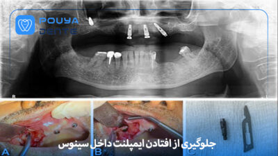 Displacement of the implant into the sinus
