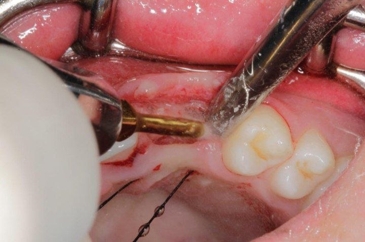 piezosurgery-in-implant-placement