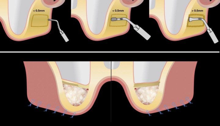 piezosurgery-in-implant-placement
