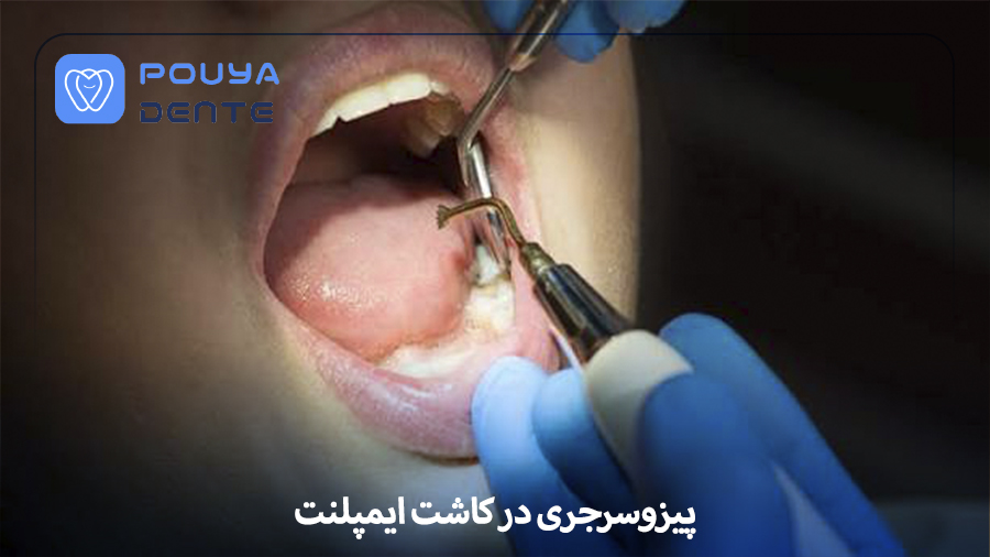 piezosurgery-in-implant-placement