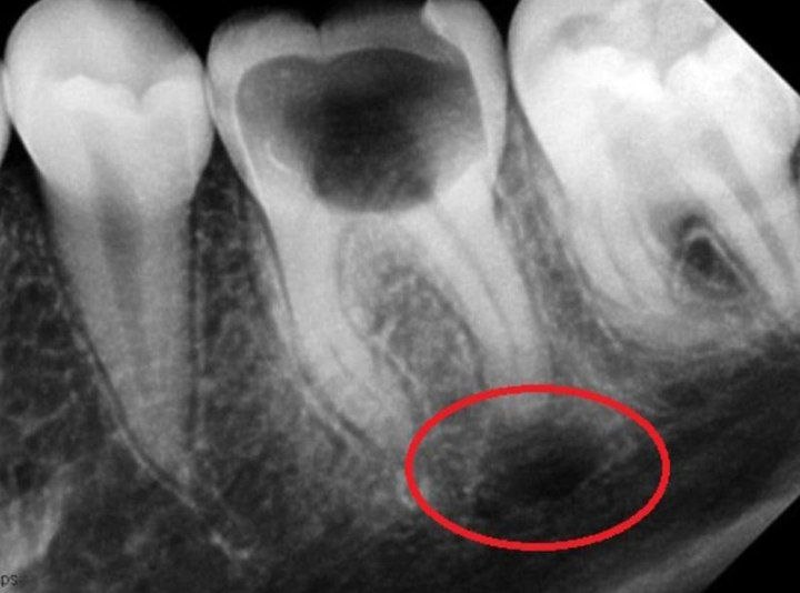 tooth-root-cyst