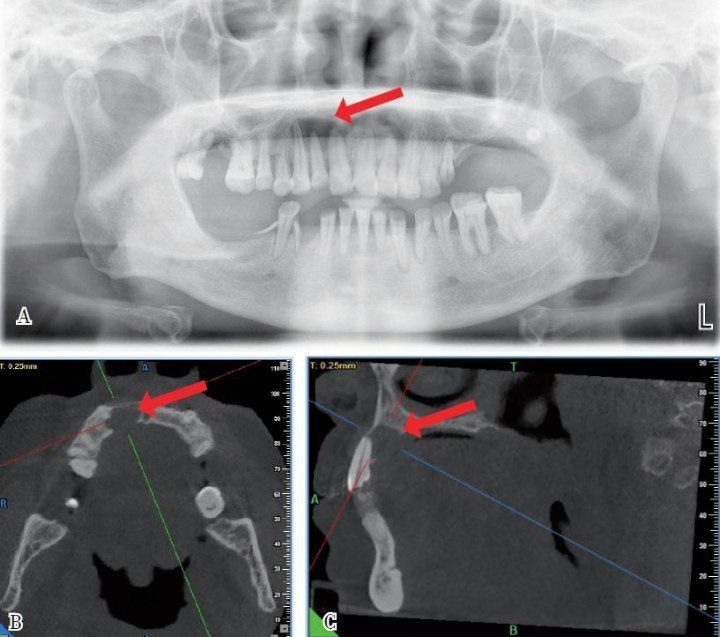 tooth-root-cyst