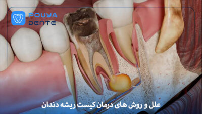 tooth-root-cyst