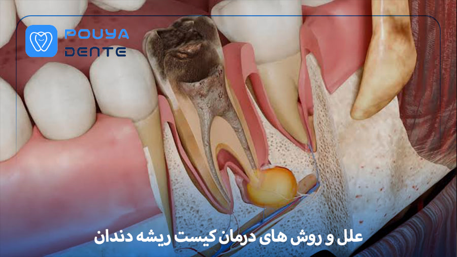 tooth-root-cyst