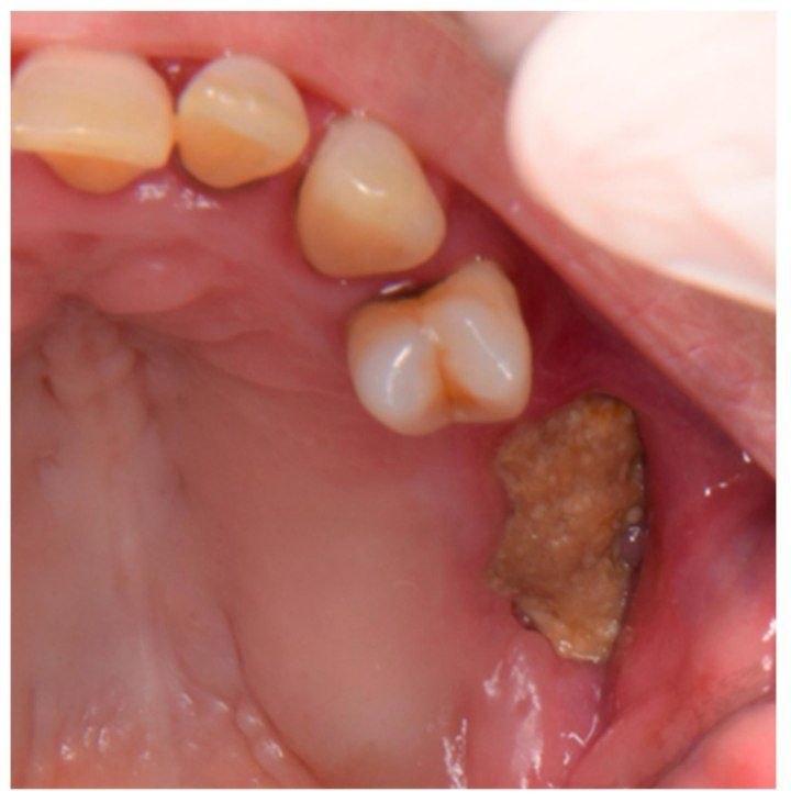 osteonecrosis-of-the-jaw