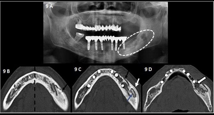 osteonecrosis-of-the-jaw