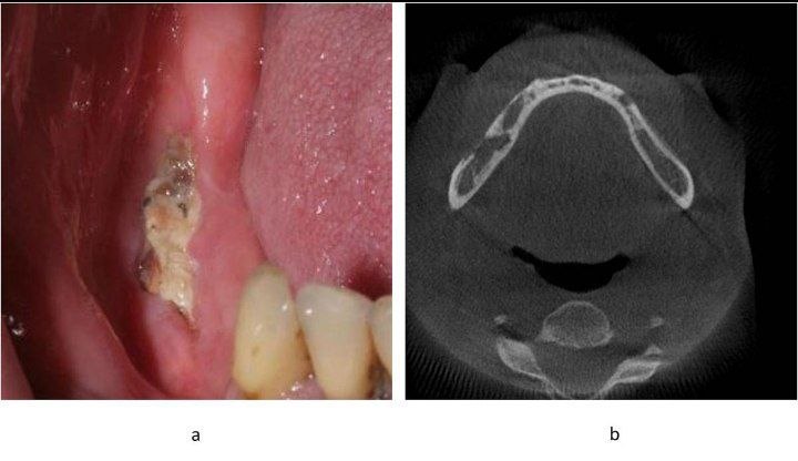 osteonecrosis-of-the-jaw
