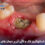 osteonecrosis-of-the-jaw