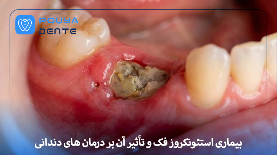 osteonecrosis-of-the-jaw
