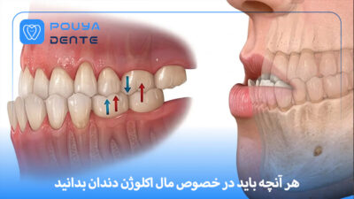 dental-malocclusion