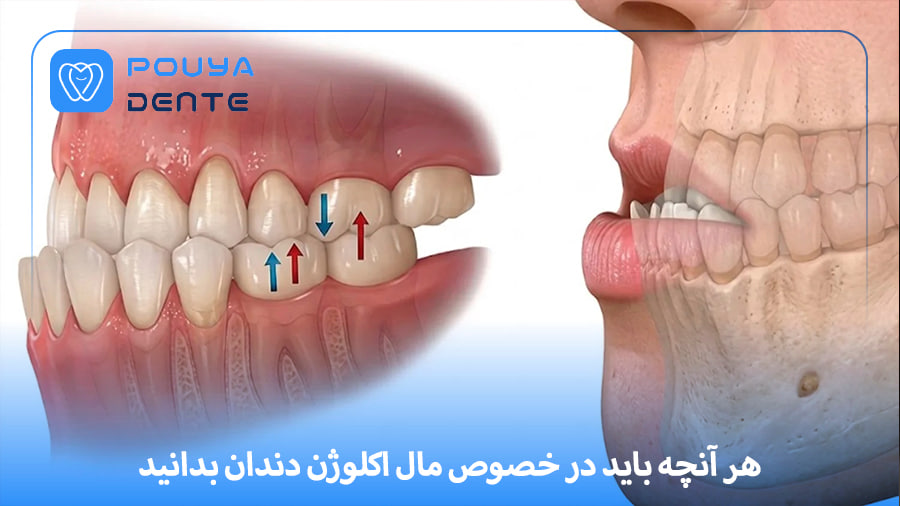 dental-malocclusion